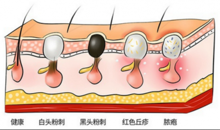 黑頭儀有用嗎？這么多款去黑頭的方法就屬它最有效