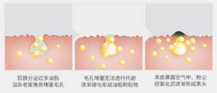 還鼻子一片“白凈”，黑頭儀有用嗎？