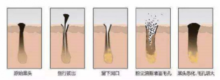 XNUO心諾黑頭儀，用科學(xué)的方法祛除黑頭