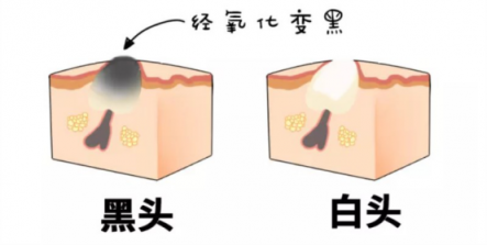 黑頭儀有用嗎？實(shí)力派去黑頭就選它！