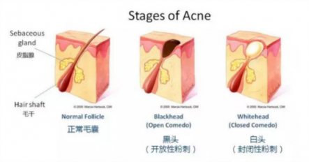 黑頭儀有用嗎？用了它終于擺脫了頑固黑頭！