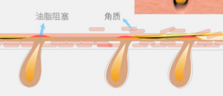 一百種去黑頭的方法都失敗了？去黑頭攻略全部拿下！
