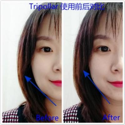 雅萌、GEVILAN歌嵐、Tripollar、NEWA美容儀到底選哪個(gè)？先評測一下再說