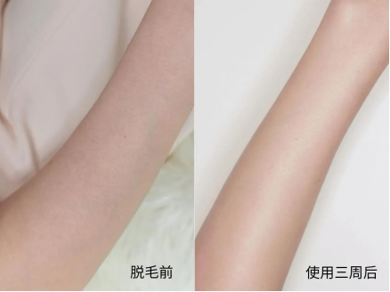 Ulike藍(lán)寶石脫毛儀：打開無(wú)痛脫毛新世界大門