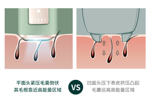 Ulike藍(lán)寶石脫毛儀：打開無(wú)痛脫毛新世界大門