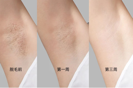 Ulike藍(lán)寶石脫毛儀：打開無(wú)痛脫毛新世界大門