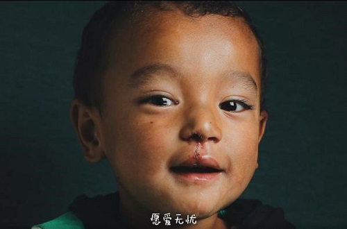 輕松集團?輕松公益助力嫣然天使西藏行 為唇腭裂患兒再謀福利