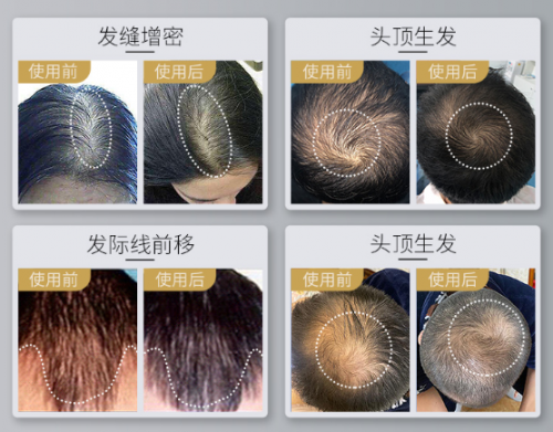 小米眾籌銷量驚人的可思美激光生發(fā)帽，真的能生發(fā)嗎？