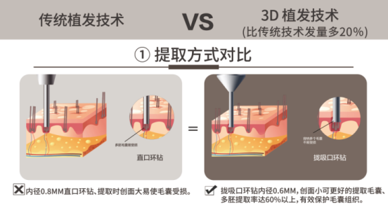 廈門(mén)新生植發(fā)：脫發(fā)人數(shù)超2.5億，雙十二消費(fèi)報(bào)告植發(fā)數(shù)據(jù)爆增