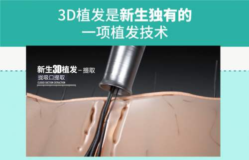 選對植發(fā)機構(gòu)多重要？杭州新生3D植發(fā)二次修復助力發(fā)友煥新顏