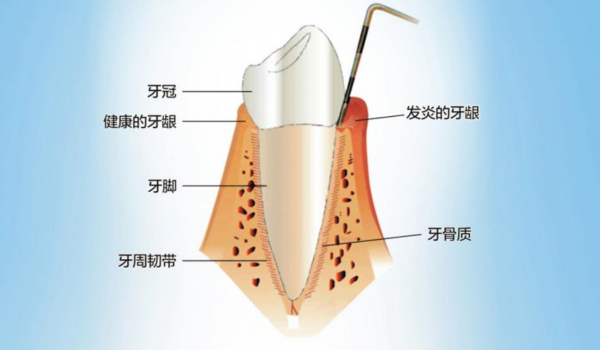 牙縫變大、總?cè)溃琛把乐懿　?/></p><p><strong>牙周病發(fā)病隱匿，早期一般無癥狀</strong></p><p>李永劍院長(zhǎng)介紹，牙周病是指發(fā)生在牙周組織的疾病，包括牙齦組織的牙齦病和波及深層牙周組織(牙周膜、牙槽骨、牙骨質(zhì))的牙周炎兩大類。牙周疾病是常見的口腔疾病，也是引起成年人牙齒喪失的首要原因。</p><p>“牙周病與齲齒不同，它起病隱匿，初期不會(huì)疼痛，早期僅有出血等輕微癥狀，且病程長(zhǎng)，可達(dá)數(shù)年之久，因此很容易被忽視。” 李永劍院長(zhǎng)表示，牙周病的早期癥狀是刷牙和咬硬物出血，如果在這個(gè)階段進(jìn)行積極治療，效果好，花費(fèi)少。如果等到出現(xiàn)疼痛、腫脹、牙齒松動(dòng)、脫落或咀嚼功能障礙時(shí)，已錯(cuò)過最佳治療時(shí)機(jī)，不僅治療難度加大，治療費(fèi)用增加，而且無法恢復(fù)到原來的健康水平。</p><p align=
