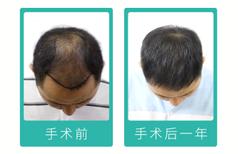 90后“禿”然崛起，常州新生植發(fā)：3D植發(fā)技術備受關注