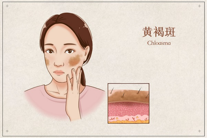 巧用仲景逍遙丸，春季養(yǎng)好肝一年少生病