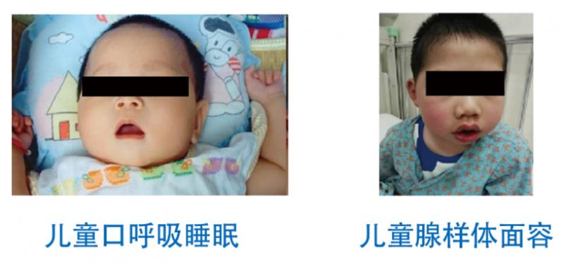 兒童腺樣體面容防控新方案：清雷科技創(chuàng)新醫(yī)療器械守護(hù)黃金睡眠